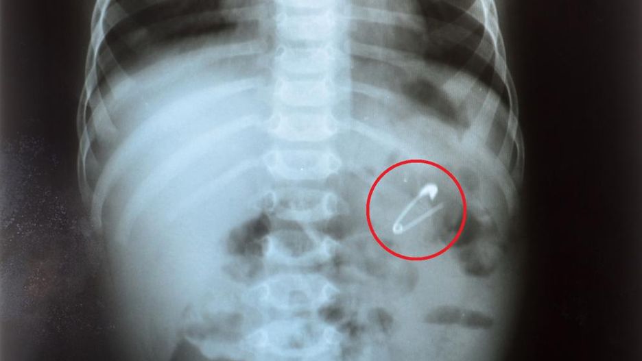 Dziecko połknęło agrafkę