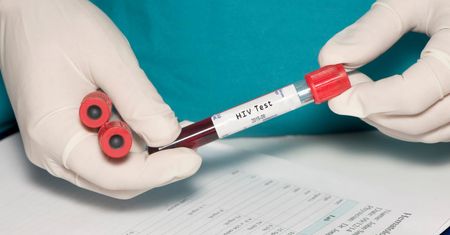 Test na HIV - metoda Western blot