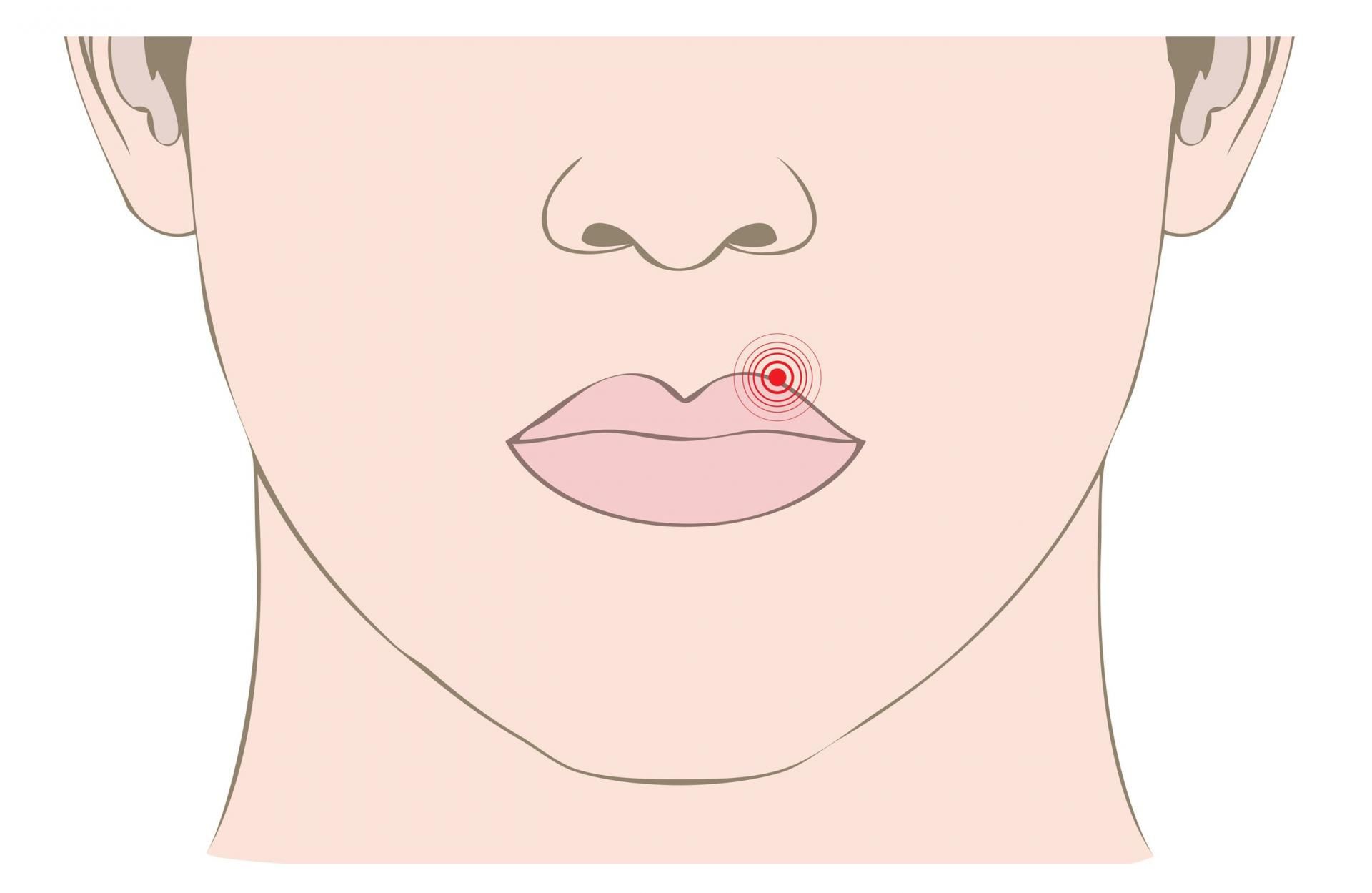 Jeżeli wirus opryszczki zaatakuje dany organizm to, niestety, ale zostanie w nim do końca życia
