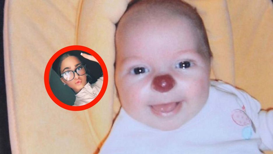 Była wyśmiewana z powodu znamienia. Dzisiaj już tak nie wygląda