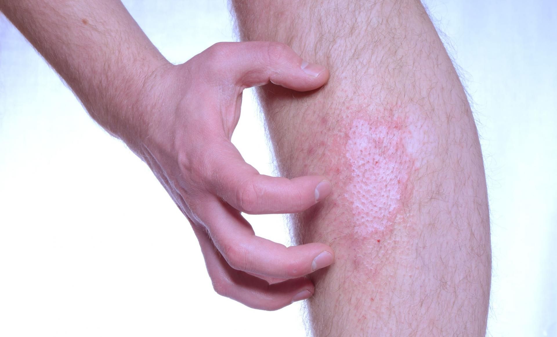 Łuszczyca to choroba, którą często dziedziczymy