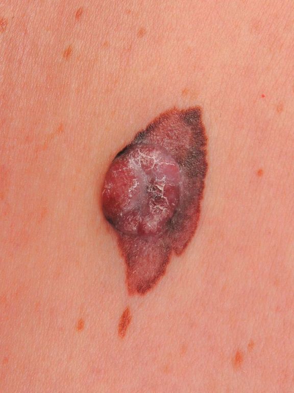 Czerniak to złośliwy nowotwór skóry