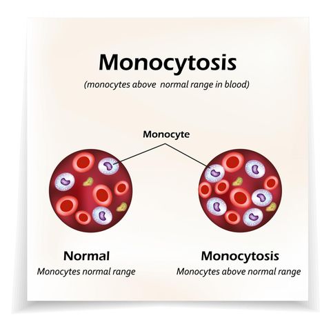 Monocytoza to zwiększenie poziomu monocytów we krwi obwodowej ponad normę.