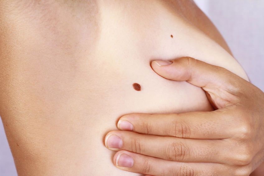 Czerniak - niebezpieczny nowotwór skóry
