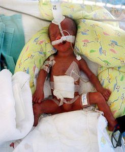 Zmarło jedno z pięcioraczków