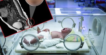 Lekarze przecierali oczy ze zdumienia. Dziewczynka urodziła się z ogonem