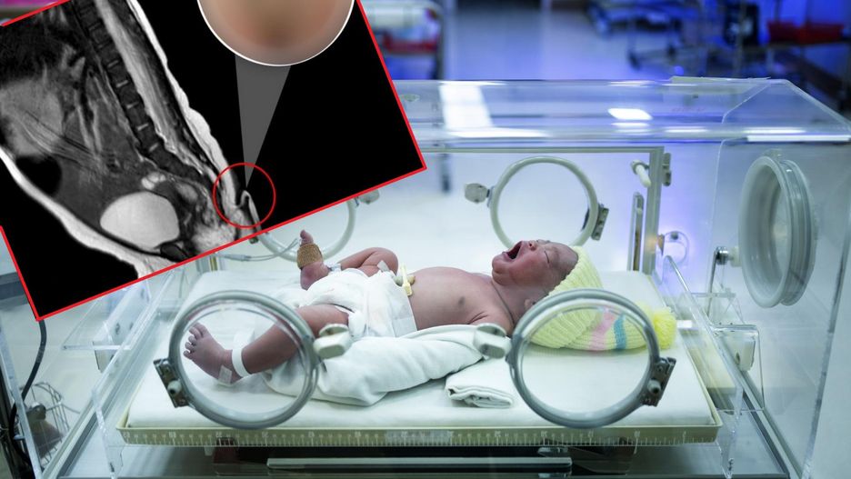 Dziewczynka urodziła się z 6-centymetrowym ogonem