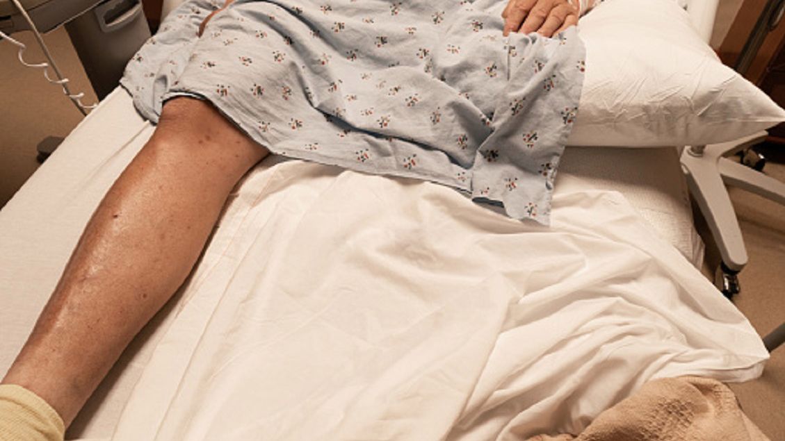 Wzrosła liczba amputacji