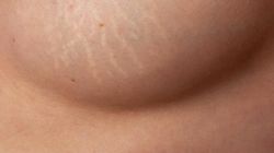 Rozstępy na piersiach - jak wyglądają i jak się ich pozbyć?