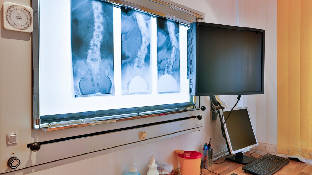 Osteoporoza niesie za sobą poważne konsekwencje zdrowotne