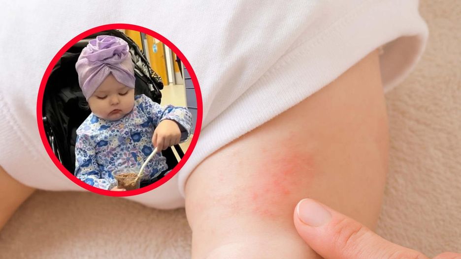 Rodziców zaniepokoiła dziwna wysypka na nogach 2-latki