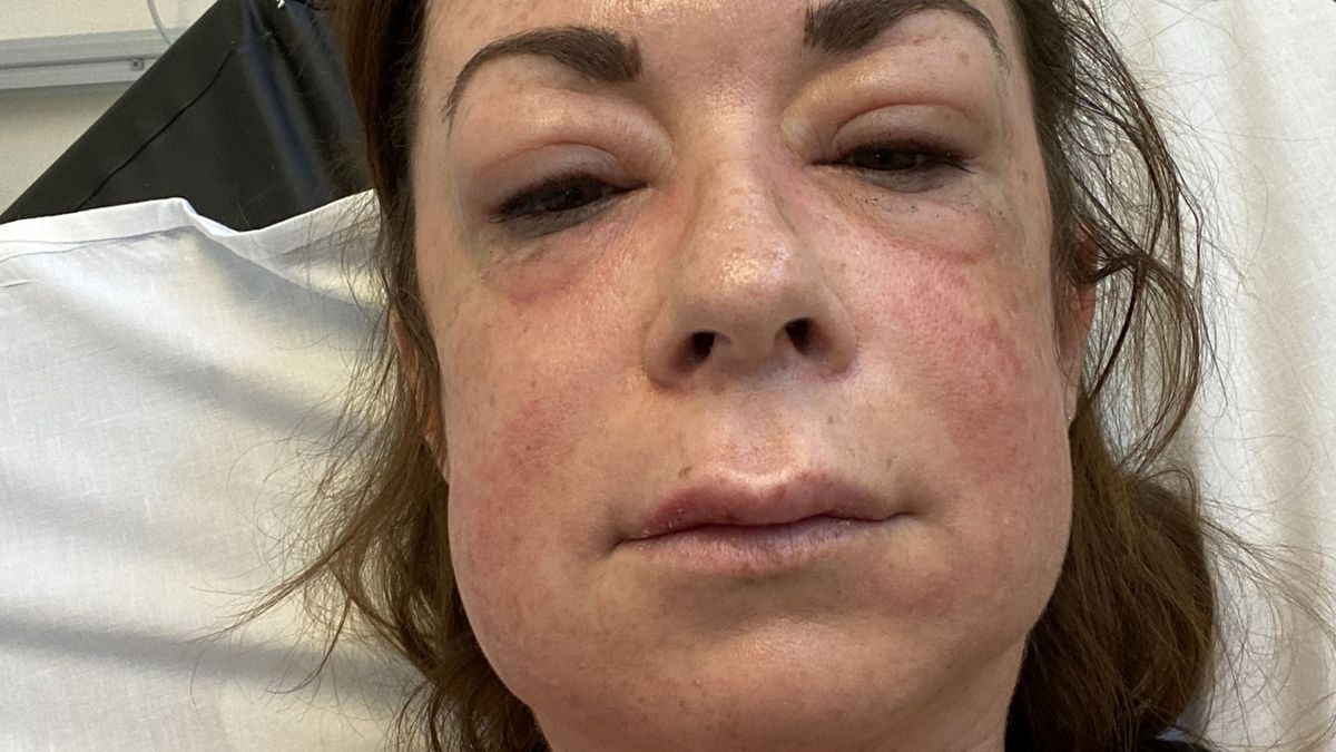 Kerry doznała reakcji anafilaktycznej