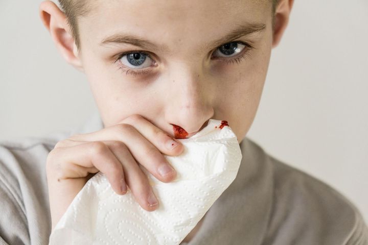 Krwotok z nosa może mieć różne przyczyny