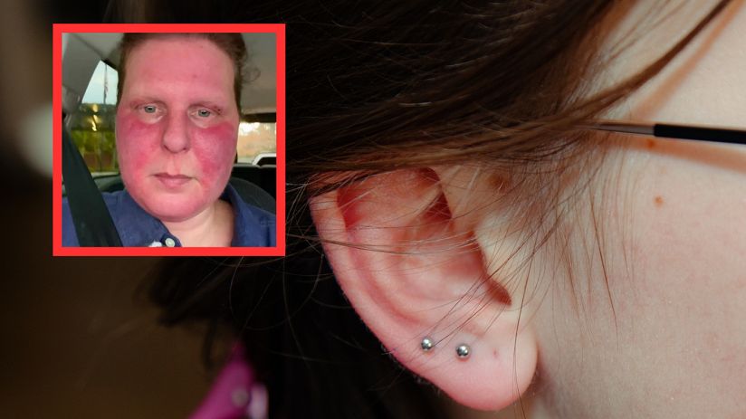 "Jakbym miała twarz przed piekarnikiem". Winny był kolczyk