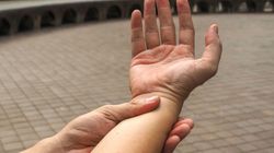 COVID-19. U pacjenta zdiagnozowano zakrzepicę kończyn górnych przy bezobjawowym przebiegu zakażenia 