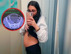 Pytali, czy jest w ciąży. To znaleźli lekarze w ciele 29-latki 