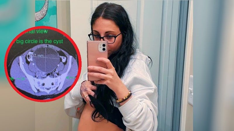 Wyglądała, jakby była w ciąży. Okazało się, że to guz