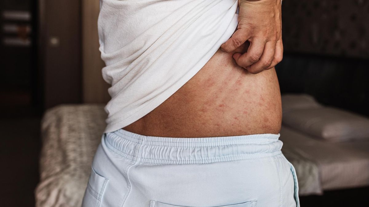 Tak objawia się bolesna choroba „wiktoriańska”