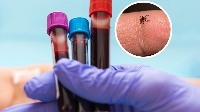 Ta grupa krwi przyciąga kleszcze jak magnes. Sprawdź, czy jesteś w grupie ryzyka