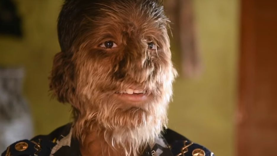 Chłopiec z syndromem wilkołaka