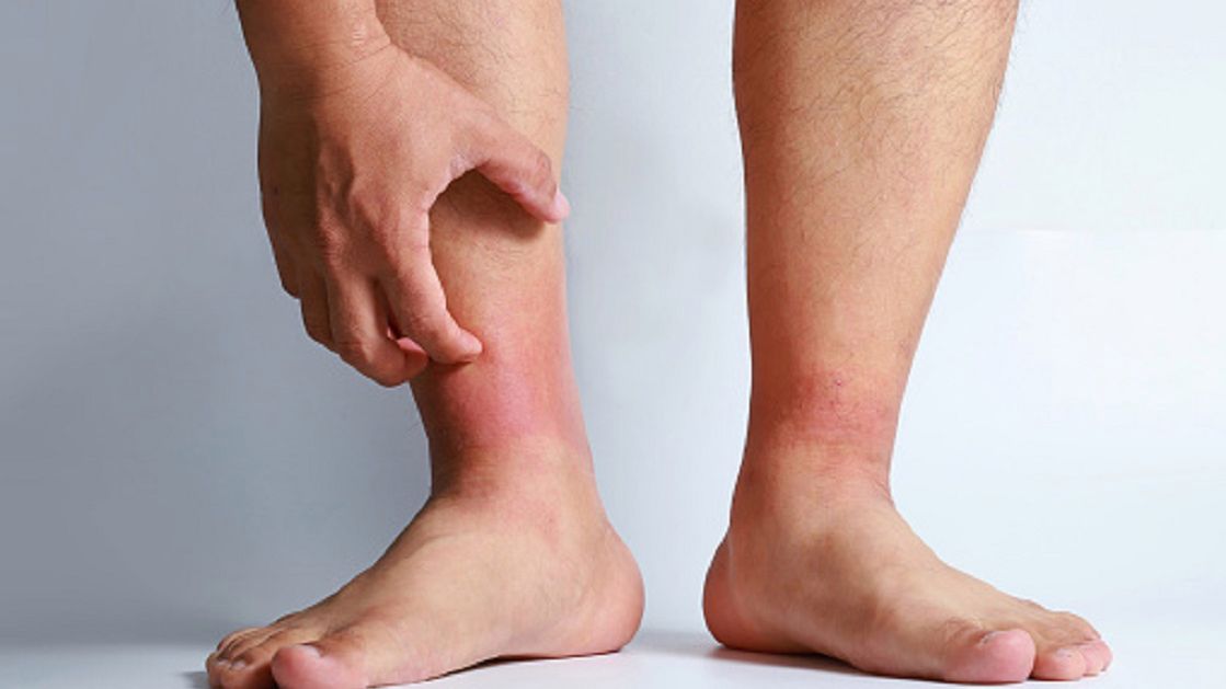 Koronawirus może powodować zmiany skórne