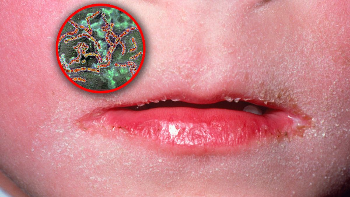 Wzrost infekcji paciorkowcami grupy A w USA. Czym są i czy stanowią zagrożenie?