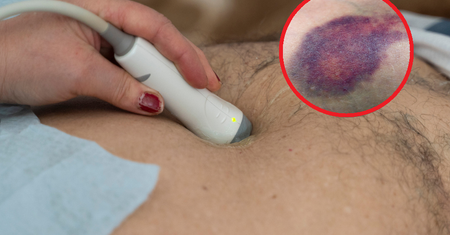 Zwiastuje ostre zapalenie trzustki. Pod żadnym pozorem nie ignoruj znaku Cullena
