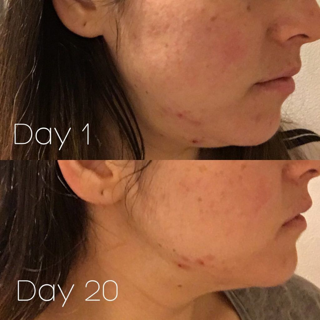 Poprawa stanu skóry była niewielka [buzzfeed.com](https://www.buzzfeed.com/ariellecalderon/more-sugar-more-problems?utm_term=.vfGqd3BkA#.nikajenvo)