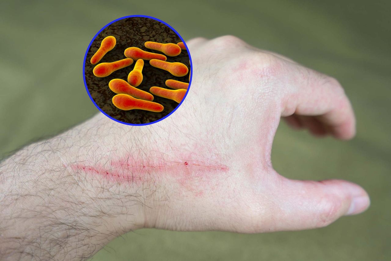 Nowe zagrożenie we Włoszech. Polacy też nie są bezpieczni, wystarczy mała rana