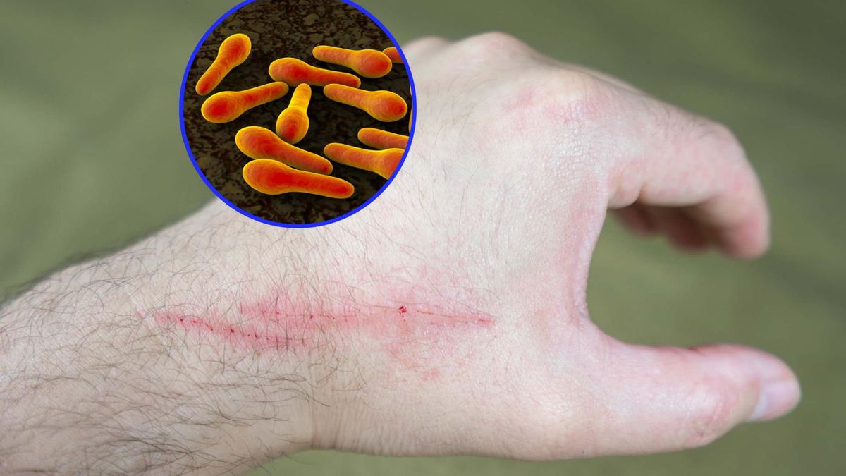 Śmiertelność w przypadku tężca jest bardzo duża