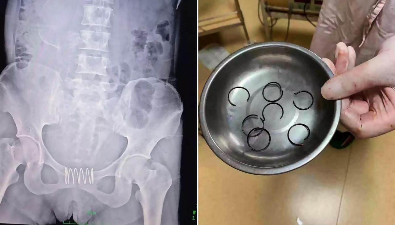 Włożyła do pochwy metalową sprężynę. Myślała, że będzie chronić przed ciążą jak spirala antykoncepcyjna