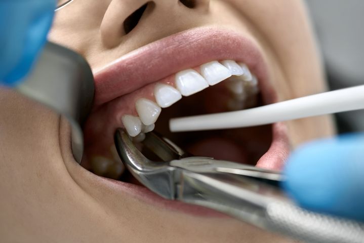 Exacyl to lek stosowany między innymi po ekstrakcji zęba.