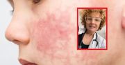 Dziecko wygląda jak "spoliczkowane"? To może być choroba zakaźna