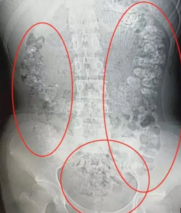 Nastolatka po bubble tea nie mogła się wypróżnić