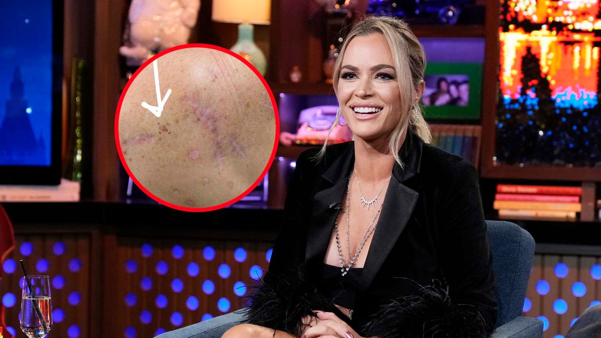 Gwiazda pokazała zdjęcie pieprzyka, który okazał się nowotworem