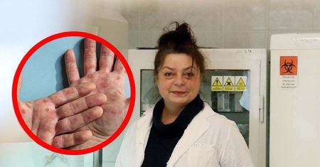 Wirus mpox już w Europie. Urodzeni przed tym rokiem mogą mieć ochronę