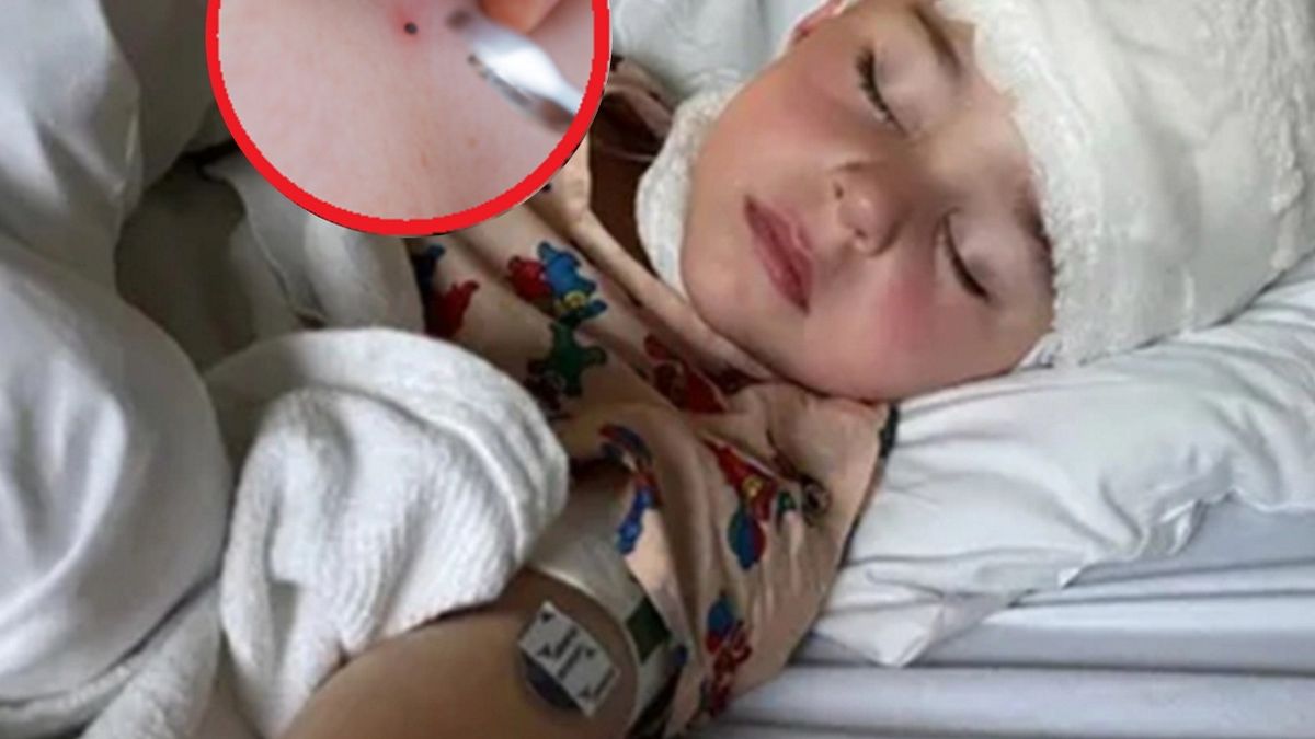 Zauważyła "czarną kropkę" na ciele 3-latka. Jego stan zaczął się pogarszać