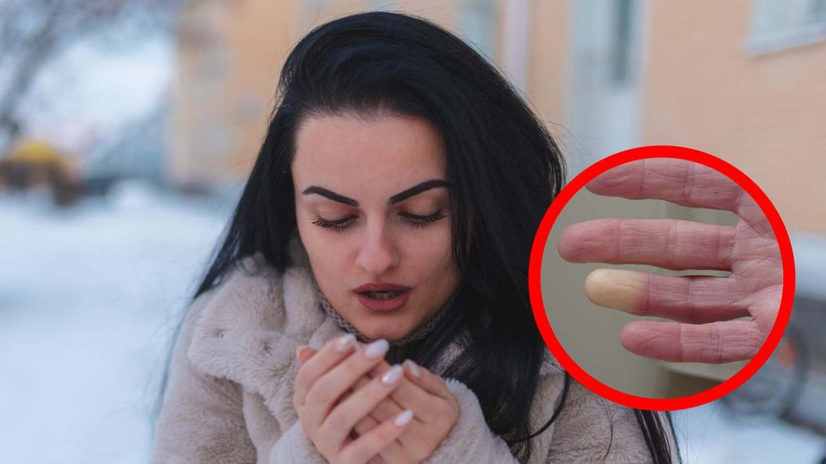 Alarmujący objaw. "Możemy go zauważyć na palcach u rąk i u stóp"