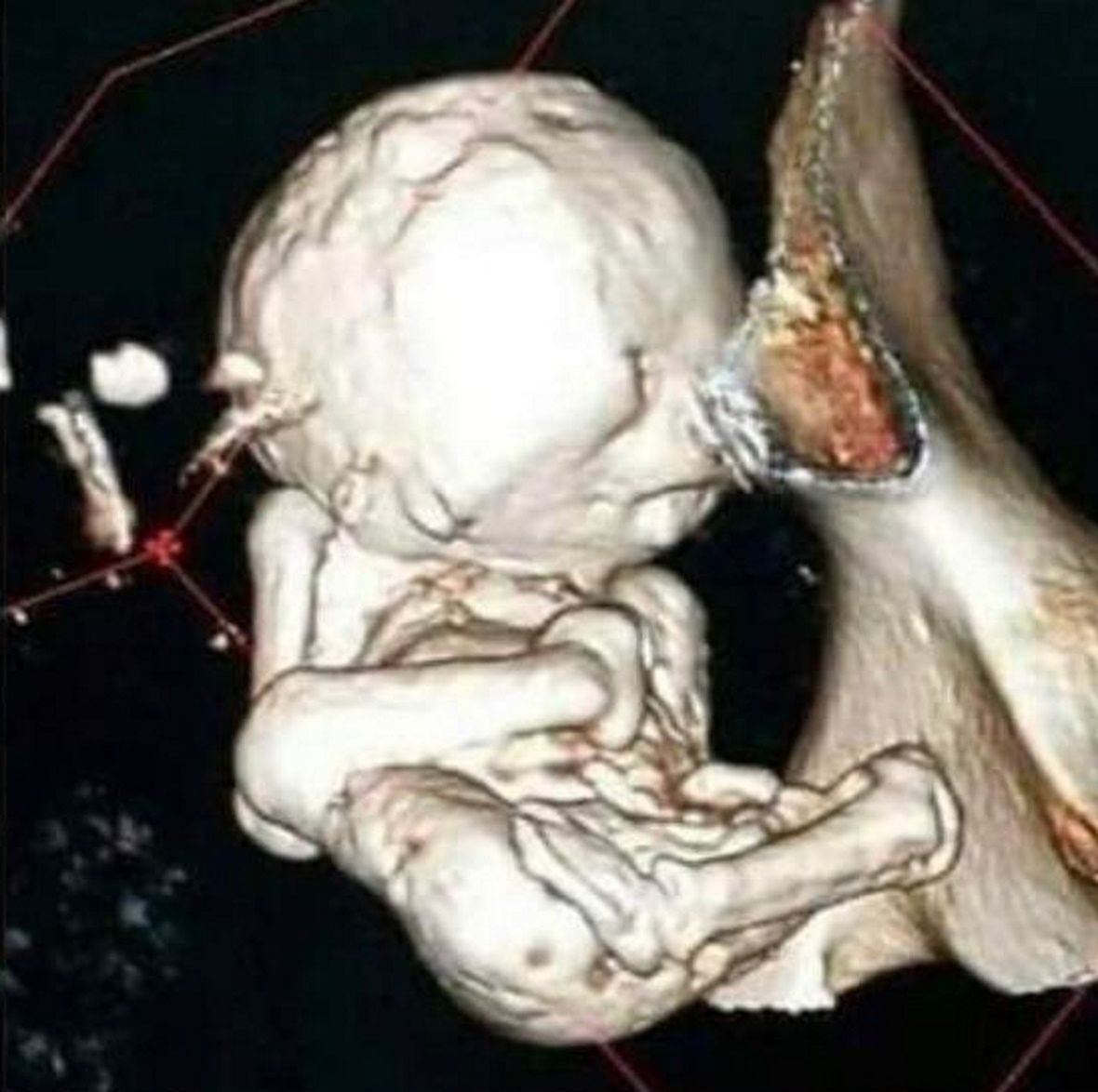 Skarżyła się a ból brzucha. W jej ciele znaleziono "kamienny płód"