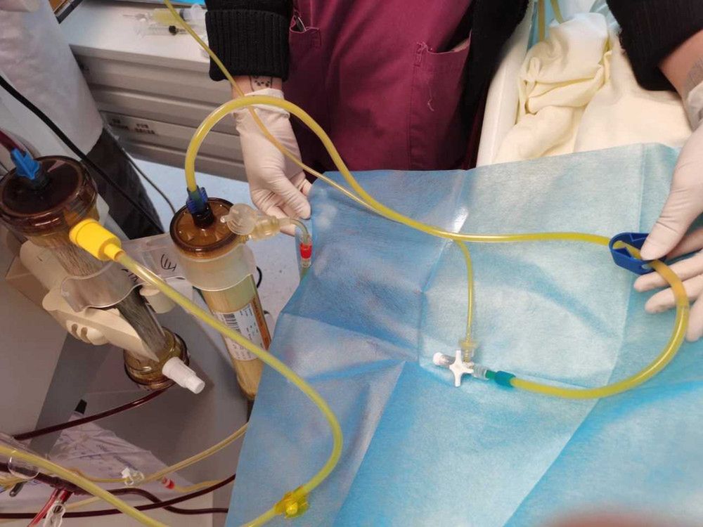 Zabieg filtracji krwi 