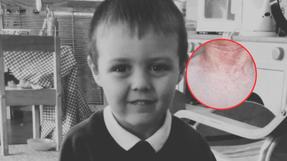 Na skórze 5-latka pojawiła się wysypka. Objaw zwiastował śmierć