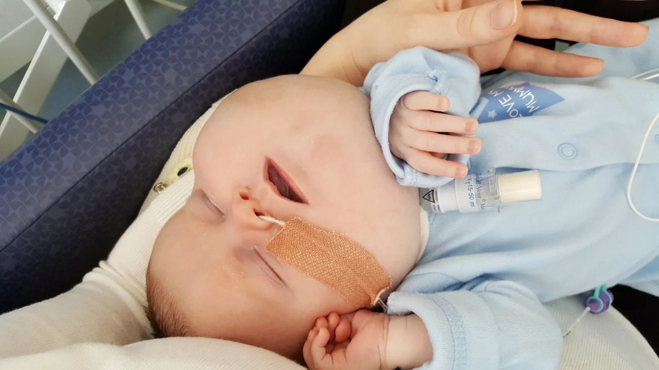 Chłopiec z cystą wielkości grejpfruta. "Mówili mi, że wygląda przerażająco"