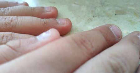 Linie Beau na paznokciach. Mogą świadczyć o przejściu choroby Kawasakiego lub zapalenia płuc