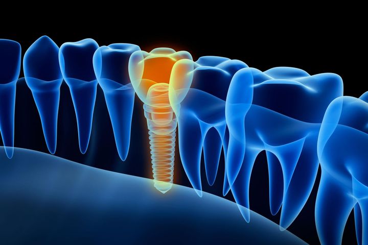 Implanty zębowe to wykonane najczęściej z tytanu sztuczne korzenie