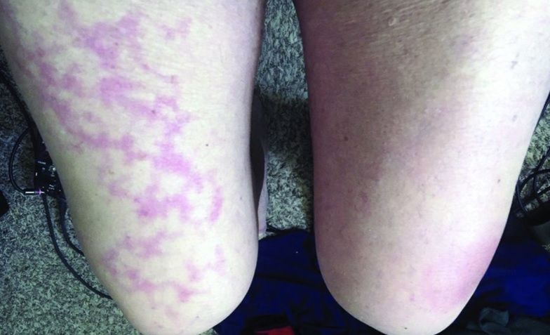 Siność siateczkowata przy COVID-19