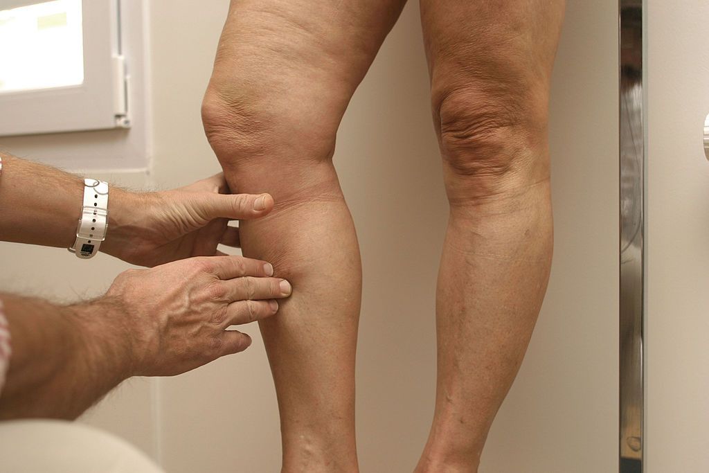 Zakrzepica po szczepieniu przeciwko COVID-19. Po ilu dniach może się pojawić i kiedy udać się do lekarza?