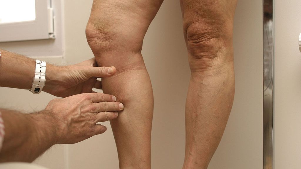 Zakrzepica po szczepieniu przeciwko COVID-19. Po ilu dniach może się pojawić i kiedy udać się do lekarza?