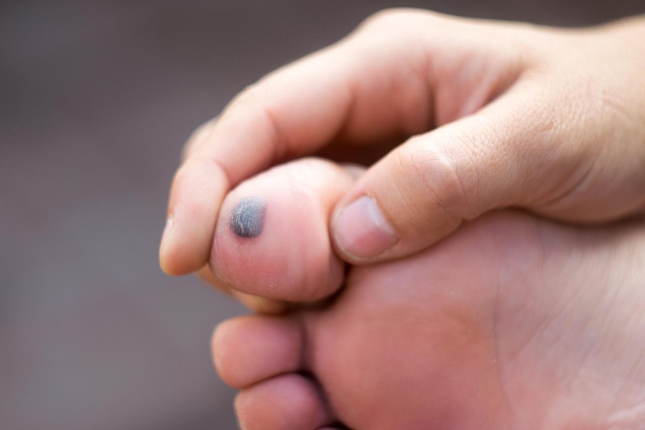 Nietypowy objaw wysokiego cholesterolu we krwi. Zmiana na palcu stopy