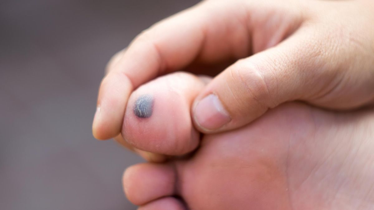 Nietypowy objaw wysokiego cholesterolu we krwi. Zmiana na palcu stopy