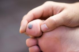 Nietypowy objaw wysokiego cholesterolu we krwi. Zmiana na palcu stopy